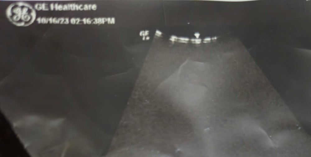 GE 4C-RS CONVEX Probe with Shadows