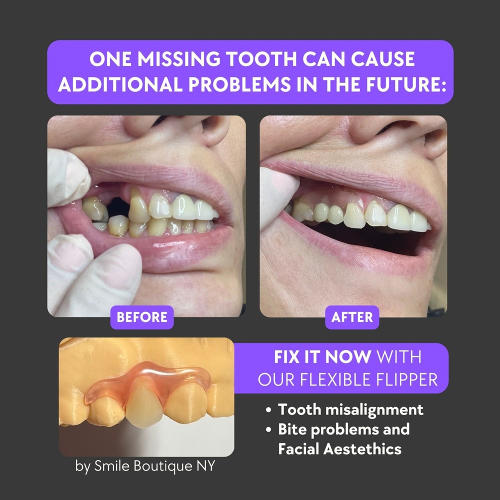 Home Impression Kit for Partial Dentures, Flippers, Removable Veneers, Retainers