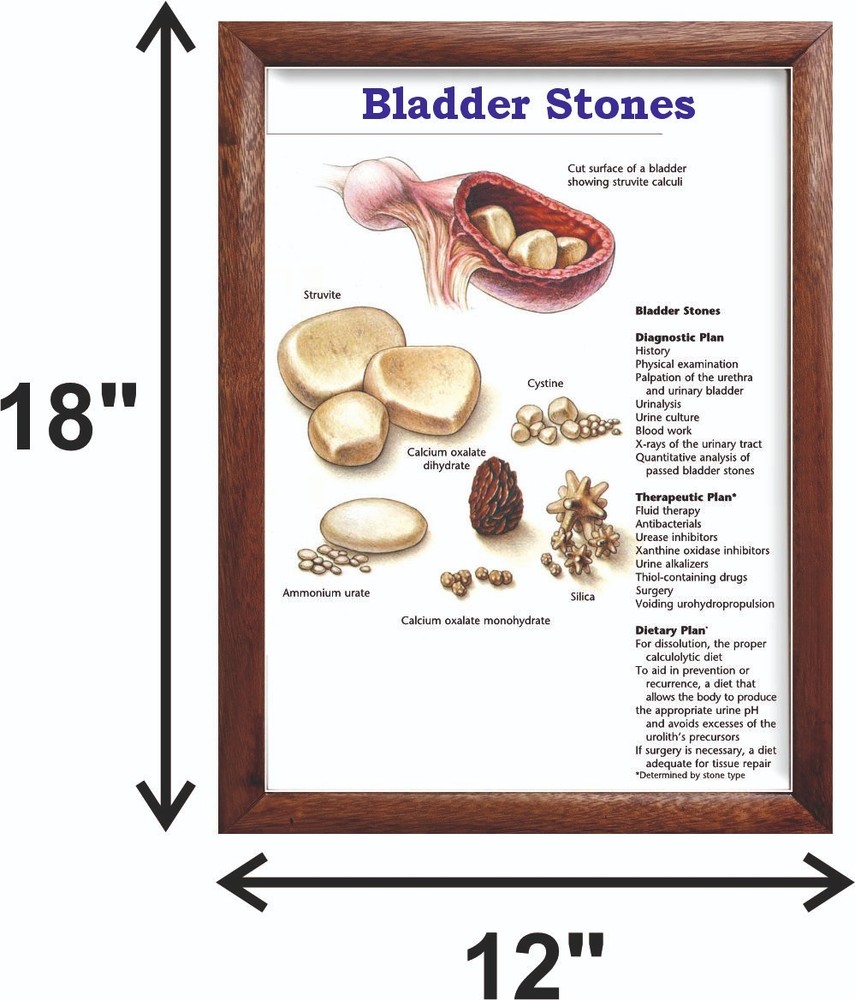 Bladder Stones Chart 12x18 inches