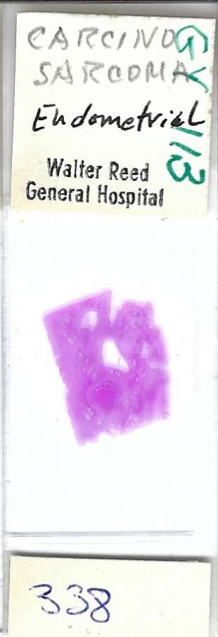Human Endometrial Carcinosarcoma Pathology Microscope Slide
