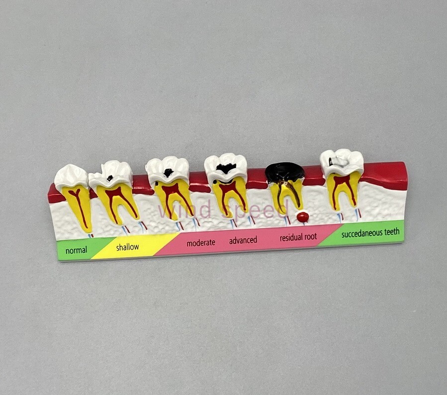 Dental lab Study Teaching Models Caries Disease Assort Teeth Dentoform Model