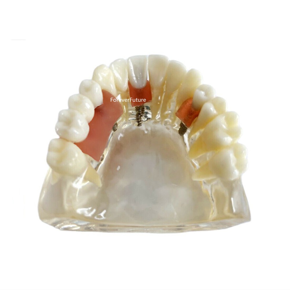 Dental Teeth model with Maryland Bridge Caries Teach Study Model