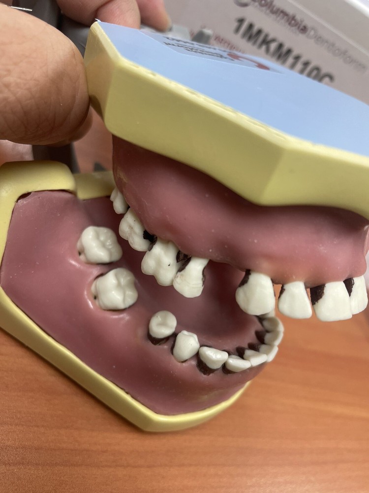 Columbia Dentoform 1mkm110c Dental Typodont Model Calculus