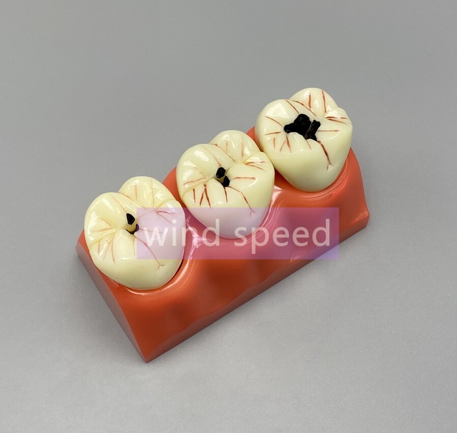 Dental Teaching Model 4 Times Caries Disassembling Comparations Implant Model