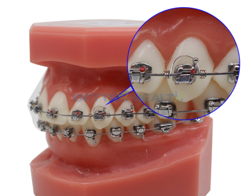 Dental Orthodontic Torquing Torque Spring Rectangular wire Single Anterior Teeth