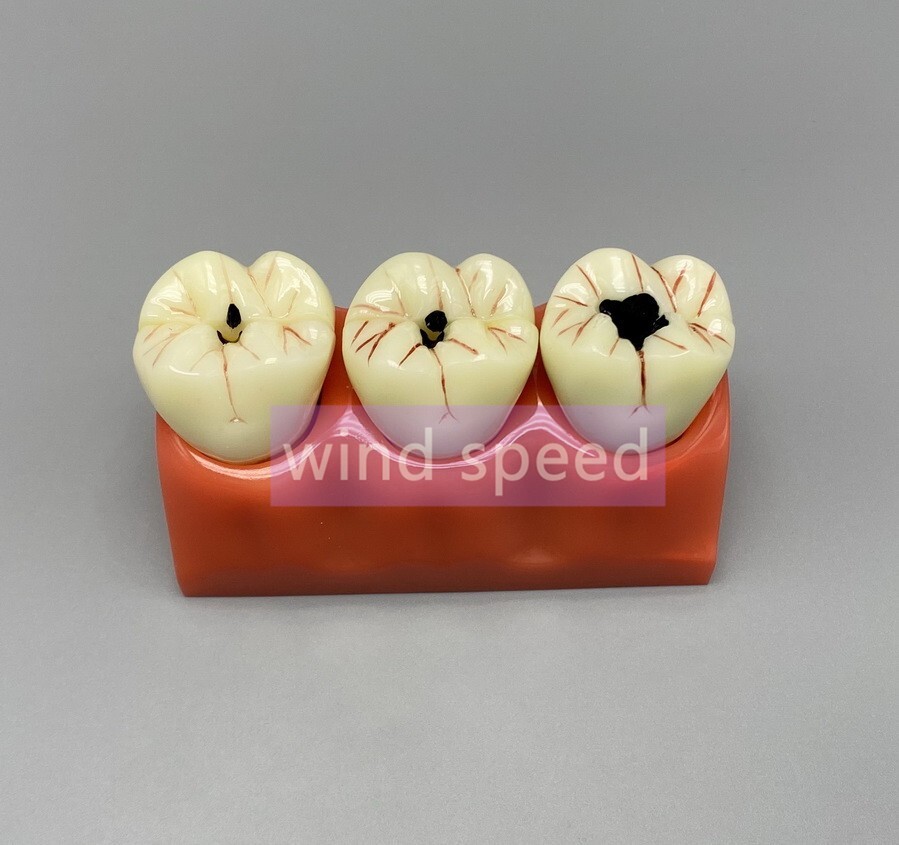 Dental Teaching Model 4 Times Caries Disassembling Comparations Implant Model