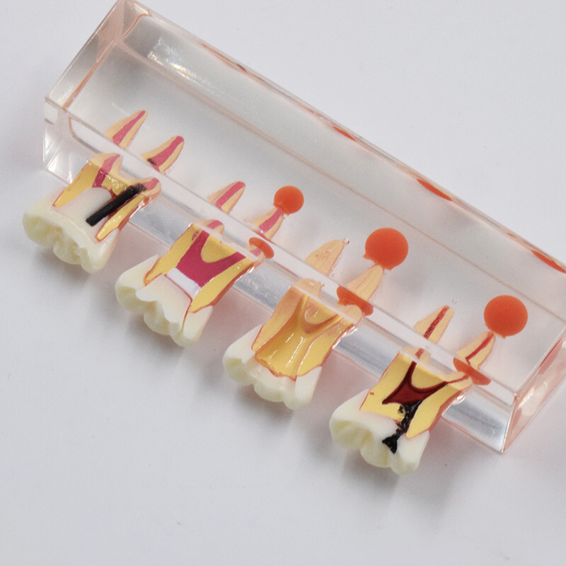 Dental Caries Disease M4018 Study Teaching Model Tooth Correcting Malocclusion