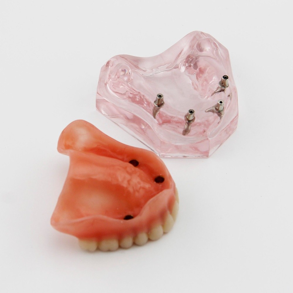Dental Implant Teeth Model Demo Overdenture Restoration Teaching Study 4 Models