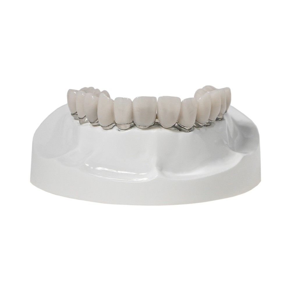 Dental Implant Disease Teeth Model Overdenture Implants Upper/Lower Demo