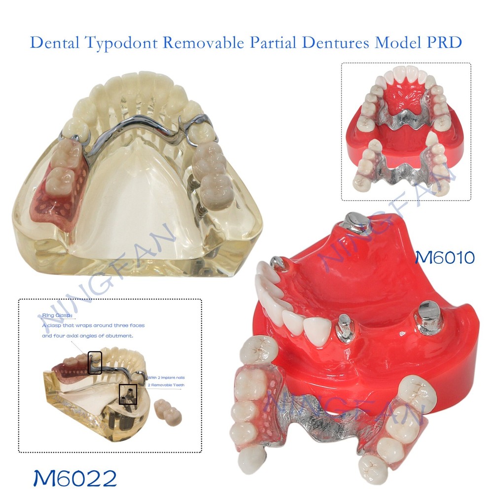 Dental Typodont Removable Partial Denture Model ,PRD Telescopic Crown Denture