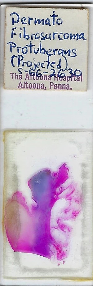 Human Dermatofibrosarcoma Protuberans Pathology Microscope Slide (1966)