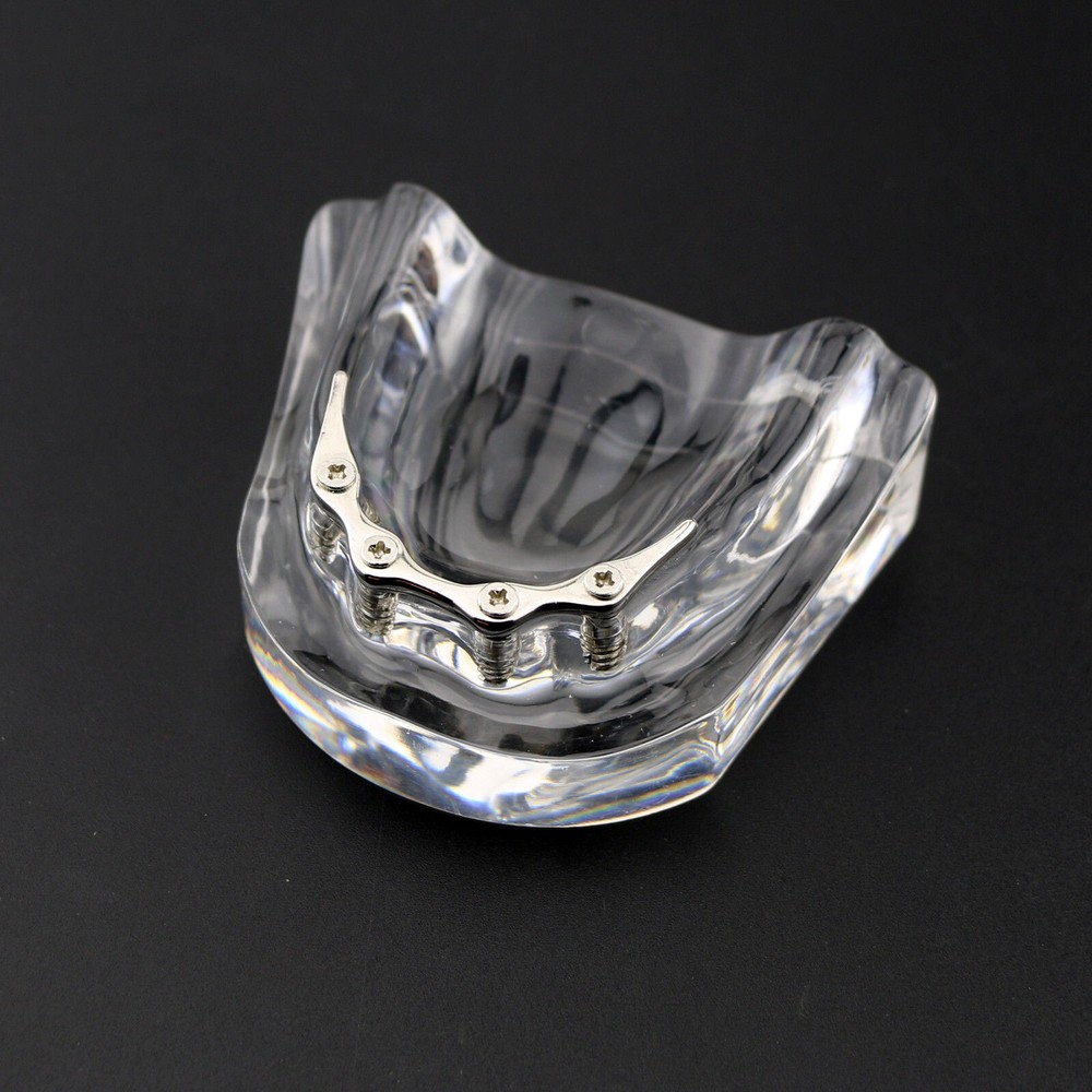 Dental Teeth Model Inferior Overdenture Precision 4 Implants Demo Silver Bar
