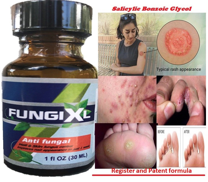 FUNGI XL ANTIFUNGAL CL EXTRA STRENGTH FUNGUS NAILS Support
