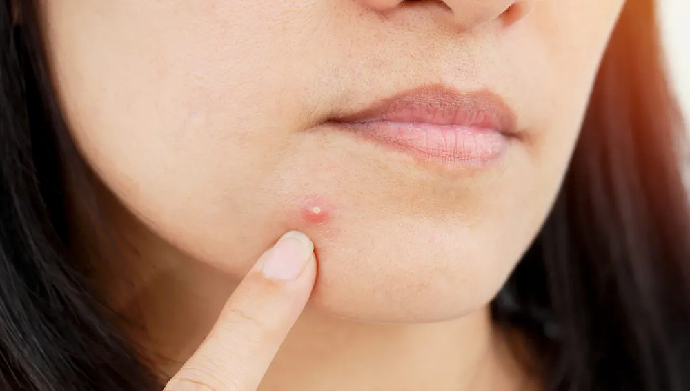 Hollywood Look Acne Patch