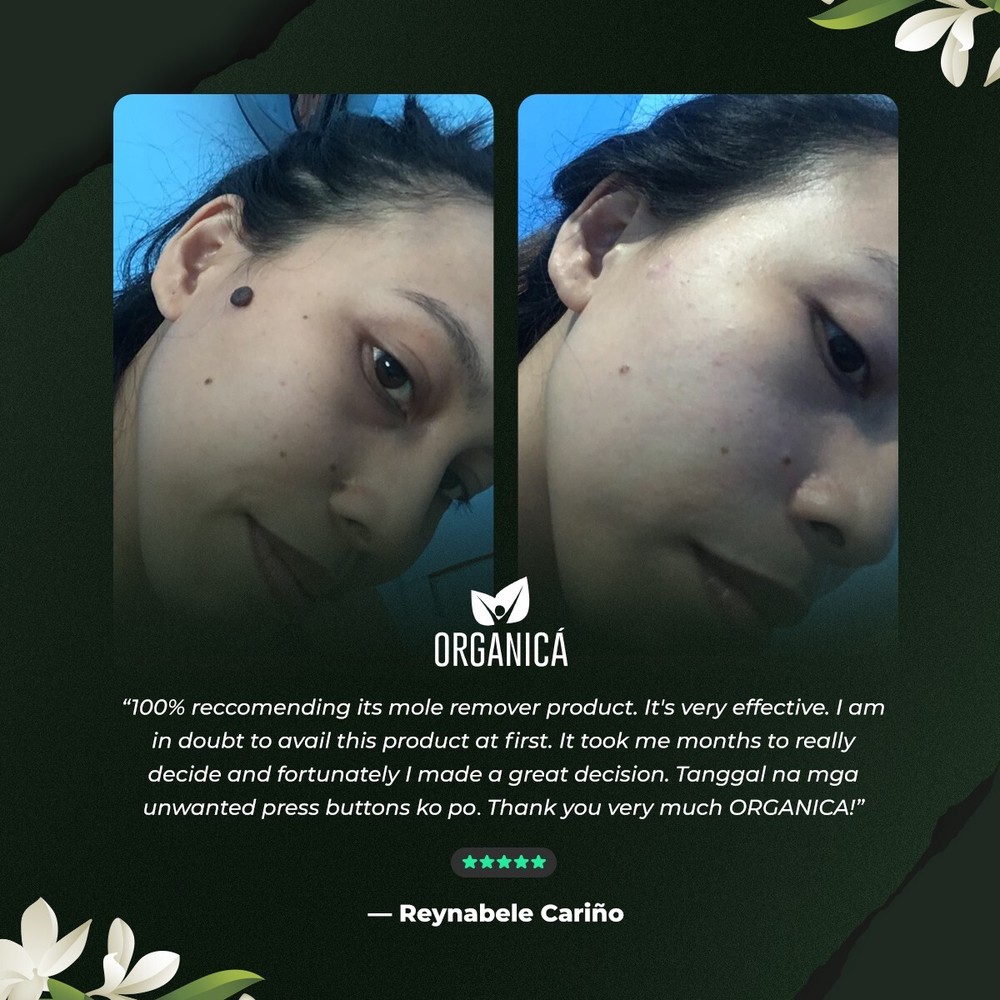 Multi-Awarded Mole and Warts Remover Set