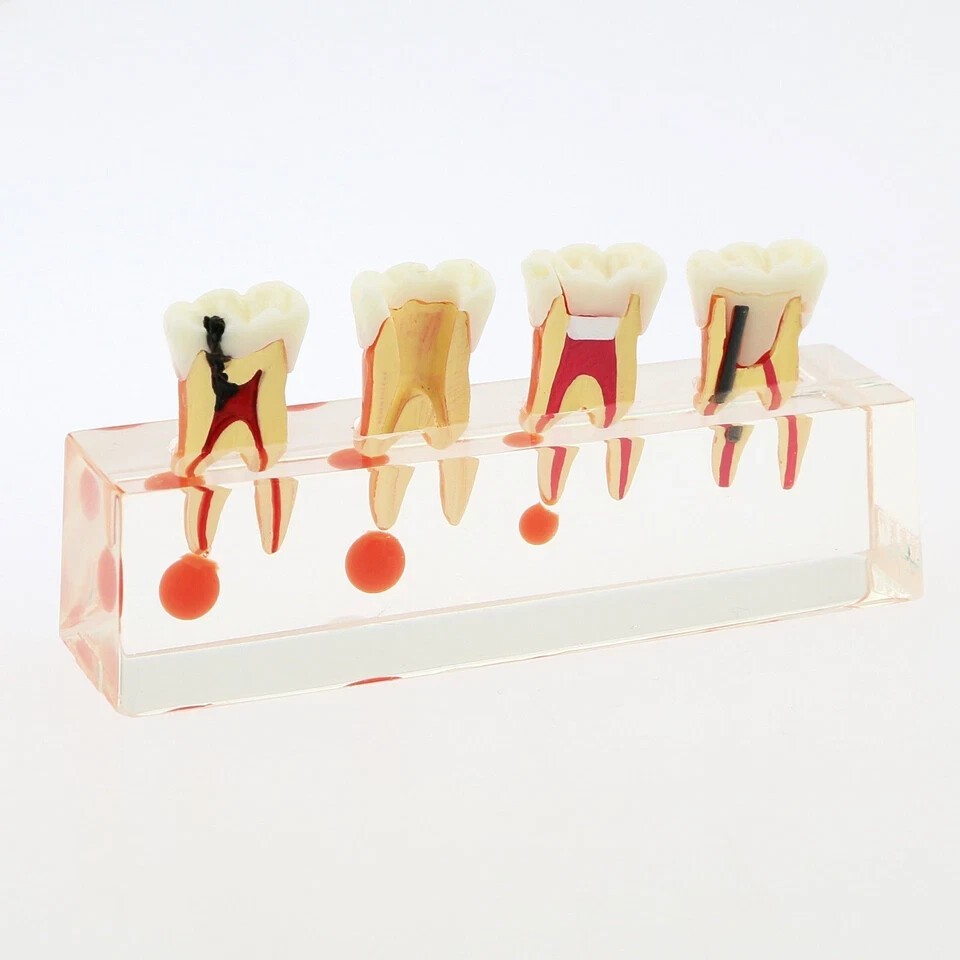 Dental Teeth Demonstrate Model #4018 Root Canal 4Stage Study Teaching Instrument