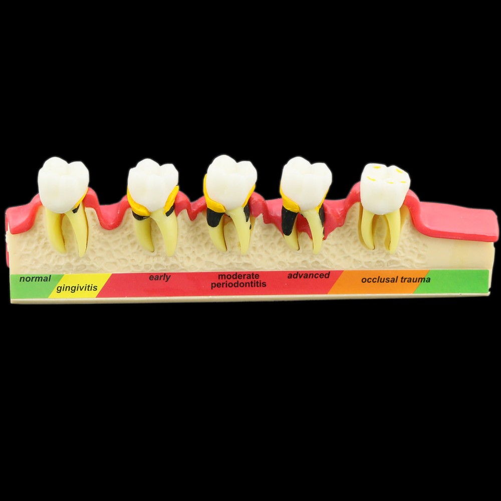 Dental Study Teaching Model Periodontal Disease Assort Teeth Dentoform Typodont