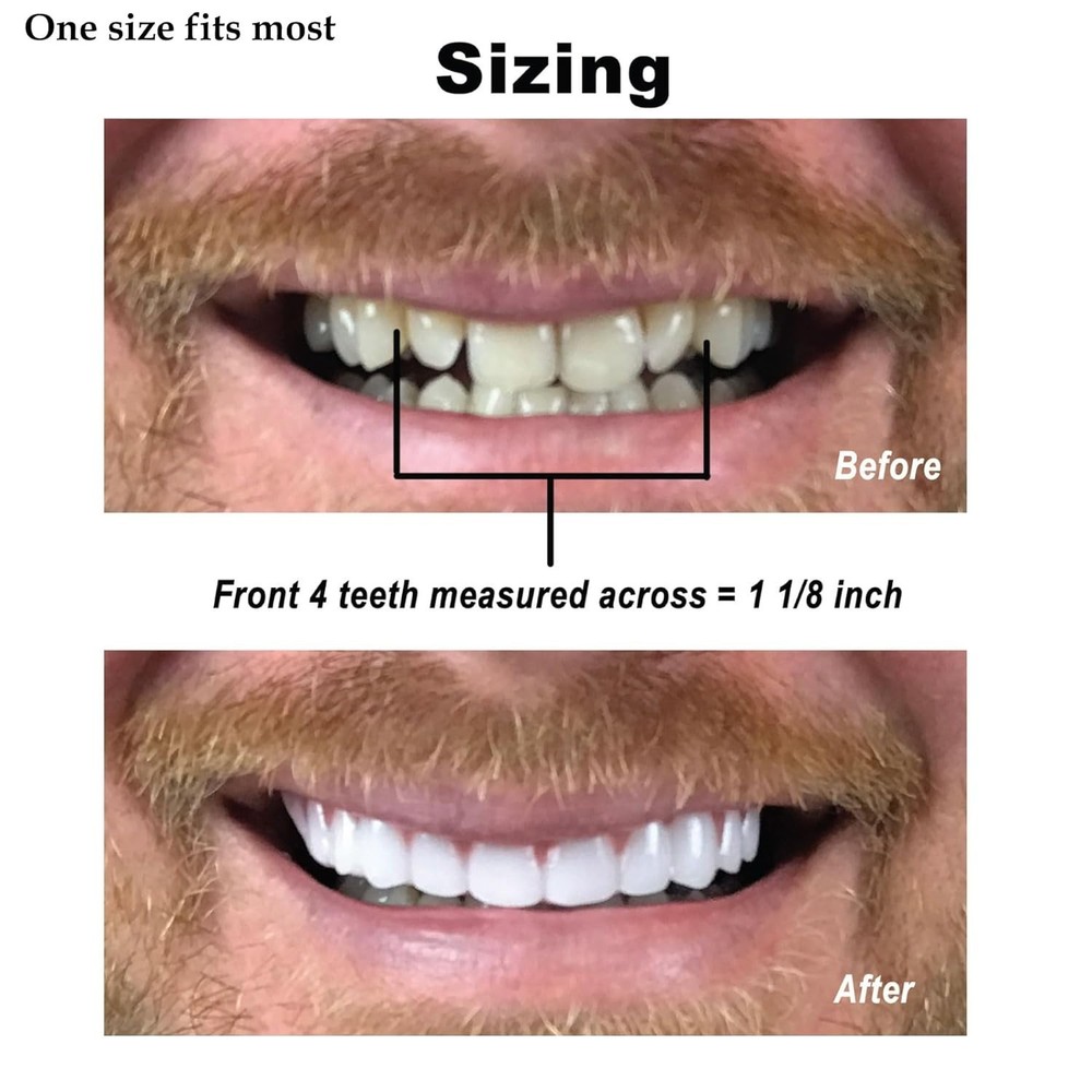 Flexible Upper Veneers for Natural Smile