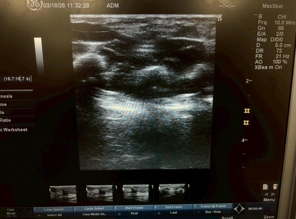 Ge ultrasound probe Linear 9LRS