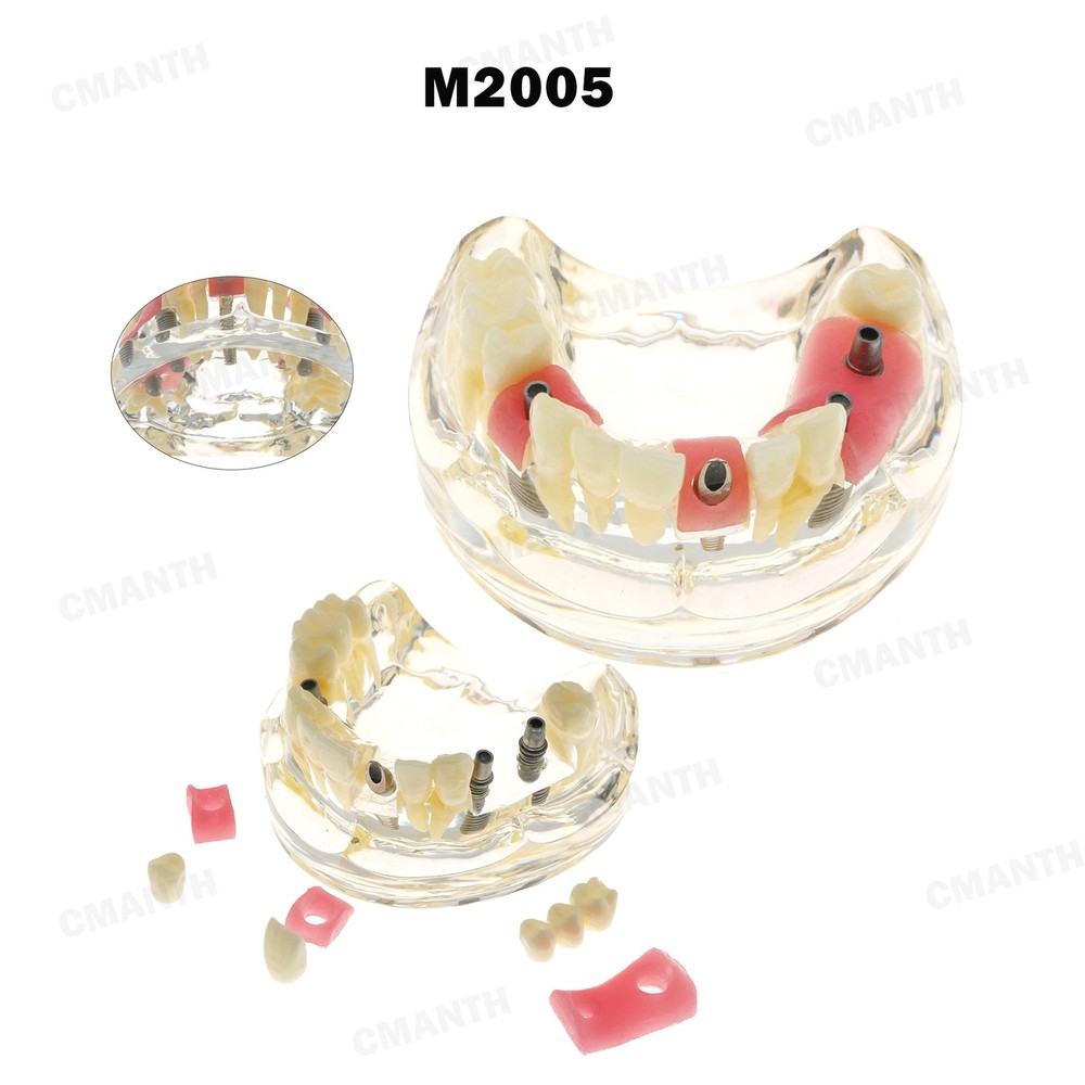 Dental Teeth Pathological Perio Practice Implant Model Studying Teaching M2005