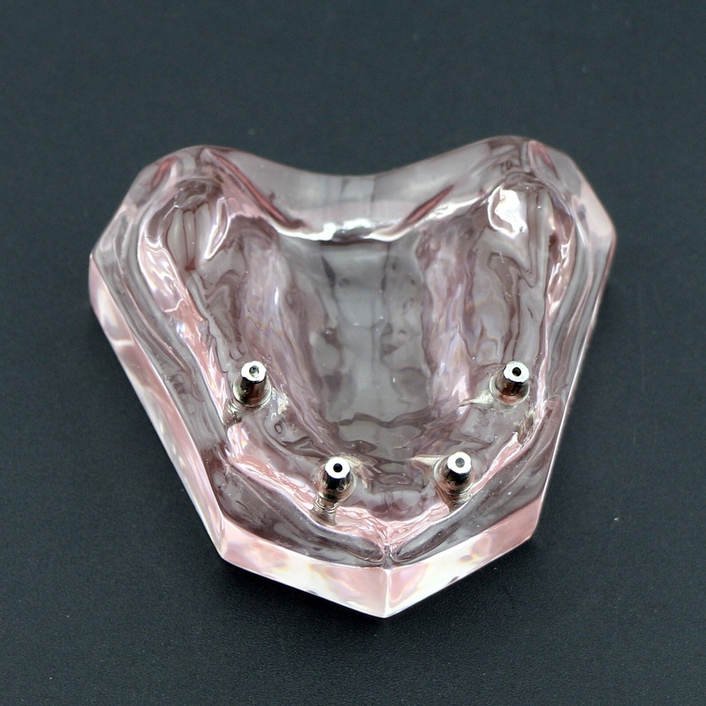 Dental Implant Overdenture Upper Superior Model Precision 4 Maxillary