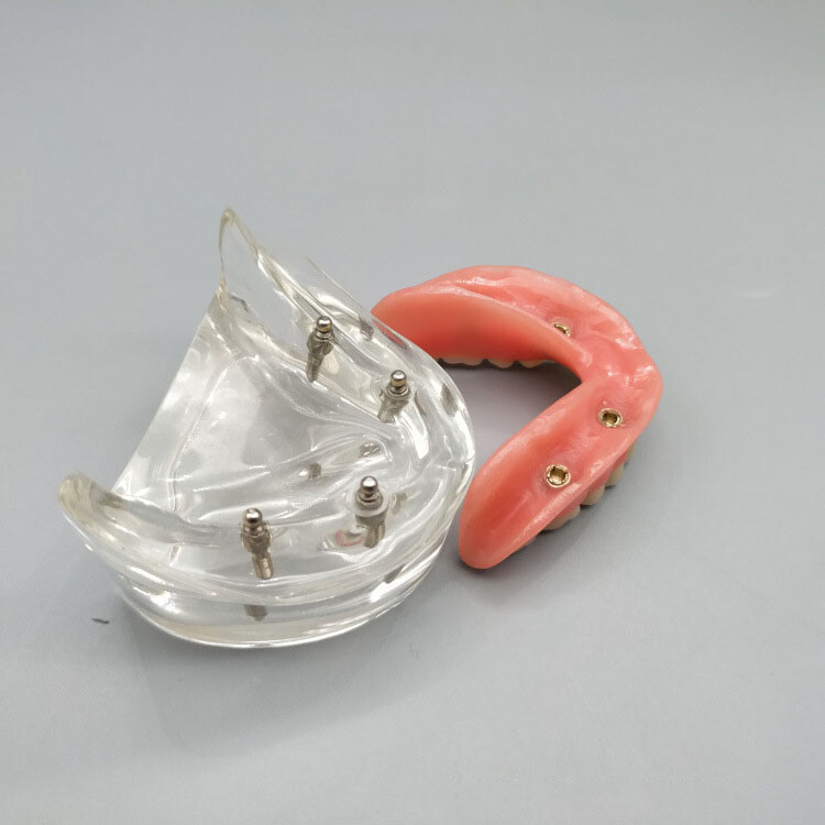 Dental Tooth Model Brushing Training Practice Implant Overdenture Restoration
