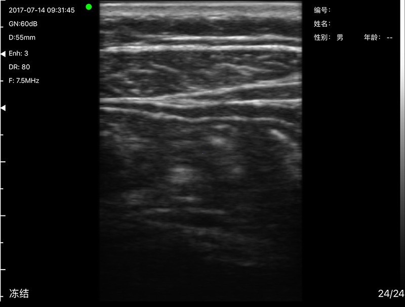 Wireless Linear Palm B/W Ultrasound Scanner – Portable Probe Type, 128 Elements