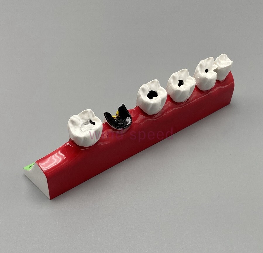 New Dental Study Teaching Models Caries Disease Assort Teeth Dentoform Model