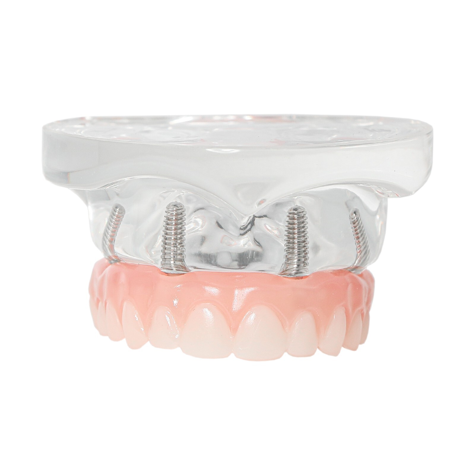 All-on-4/6 Dental Implant Model Upper/Lower Jaw Removable Screws Transparent