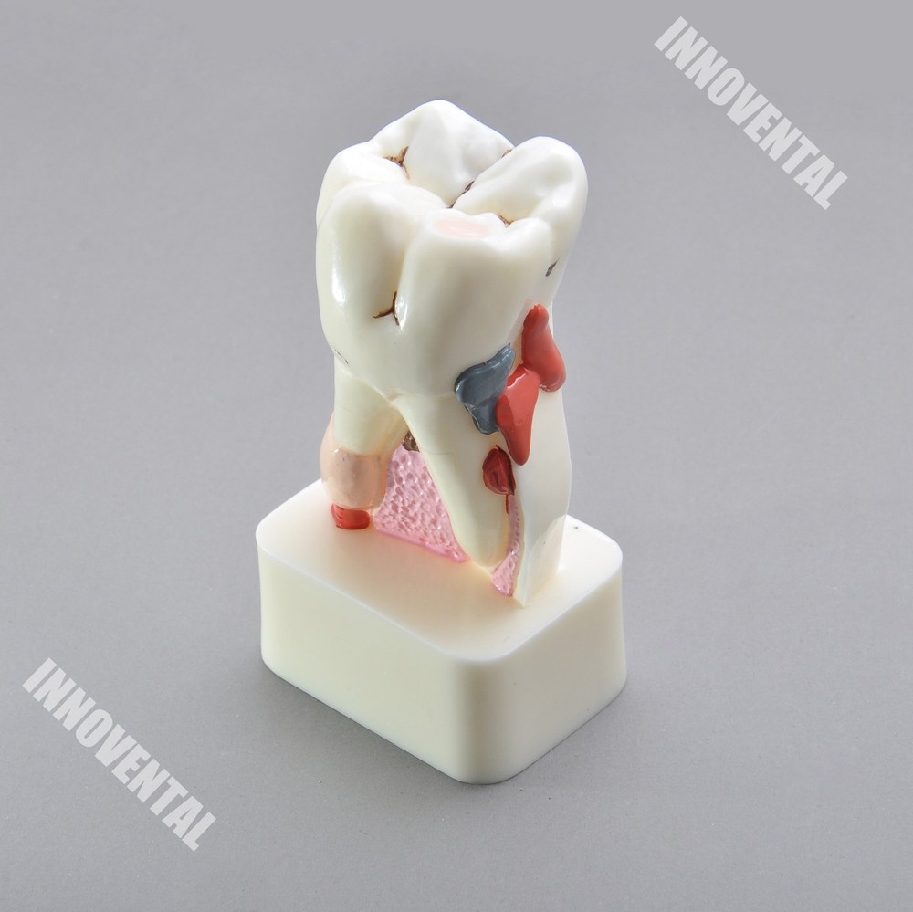Dental Model #4015 01 - Pathological Molar Study Model