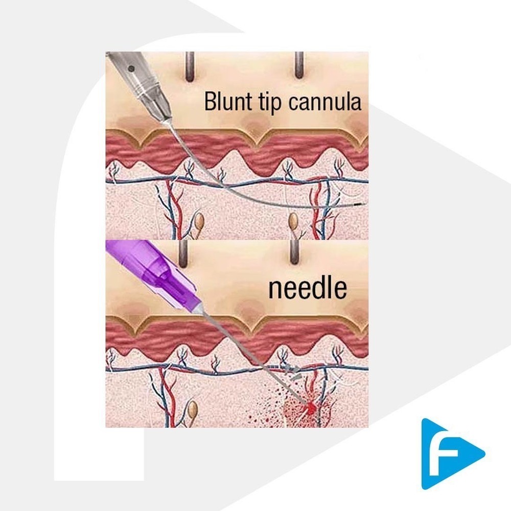 Microcannula Slim 18G - 70MM - 1box with 10 unit