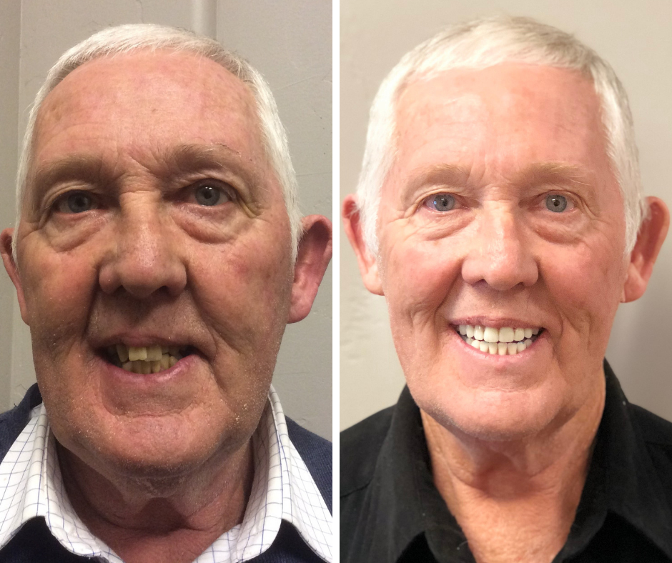 DIY DENTURE KIT Custom Homemade Dentures Temporary Teeth Tooth * FULL /PARTIAL*