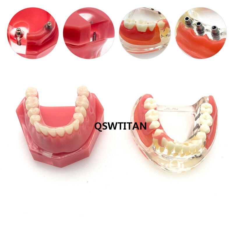 Dental Implant Restoration Teeth Model Removable Bridge Denture Teaching model