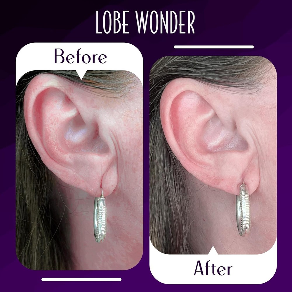 Lobe Wonder - The Original Ear Lobe Support Patch For Pierced Ears - E