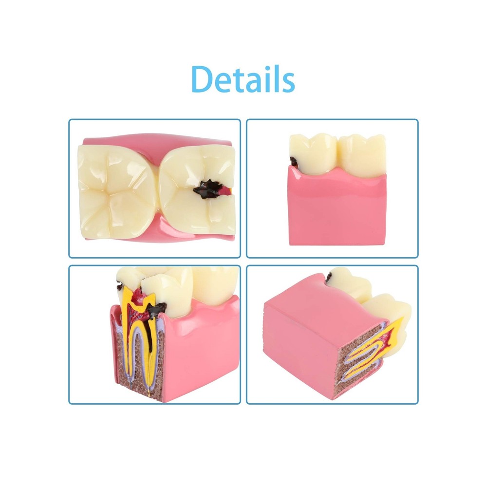 Dental Caries Tooth Model 6 Times Decay Teeth Comparative Study Model, Caries...