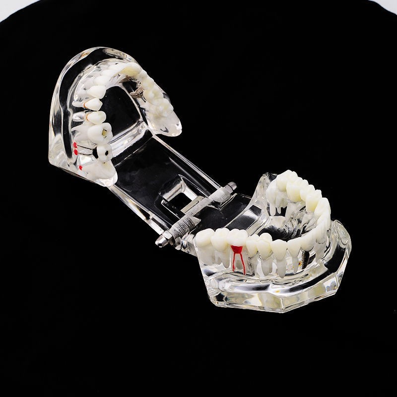 Dental Teeth Model With Restoration&Bridge Implant Disease Study Teaching Model