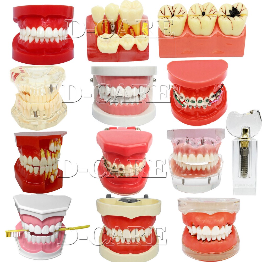 Dental Orthodontics Implant Study Model Analysis Demonstration Tooth Teaching