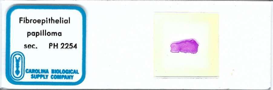 Human Fibroepithelial Papilloma Pathology Microscope Slide