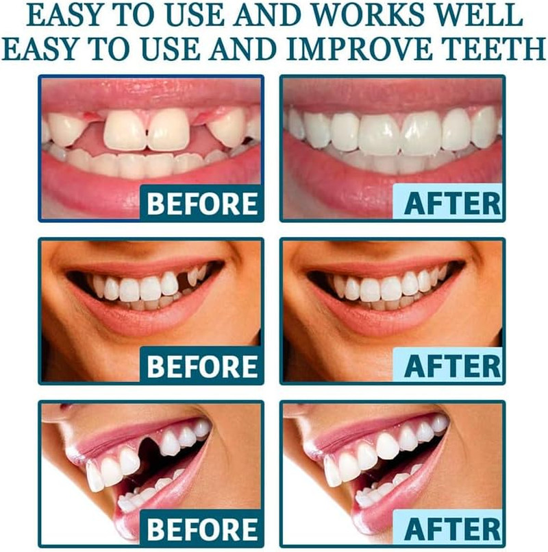 Adjustable Snap-On Dentures, Soft Safe Material, Realistic Looking Temporary Den