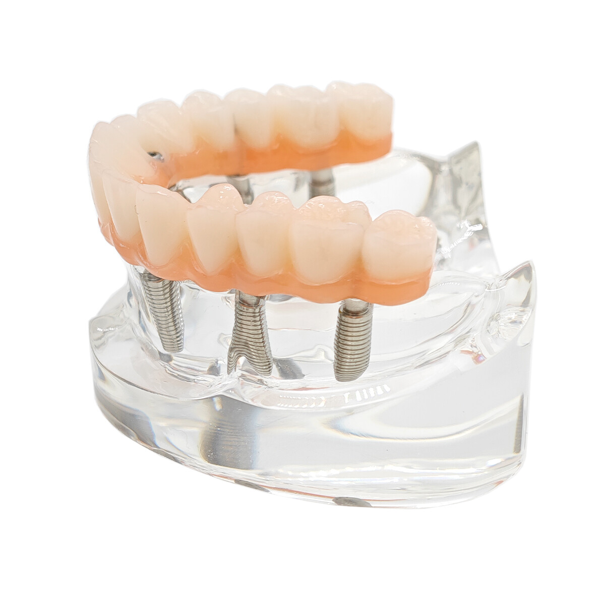 Dental Upper/Lower 4/6 Implants Demo Implant Teeth Model Restoration Overdenture