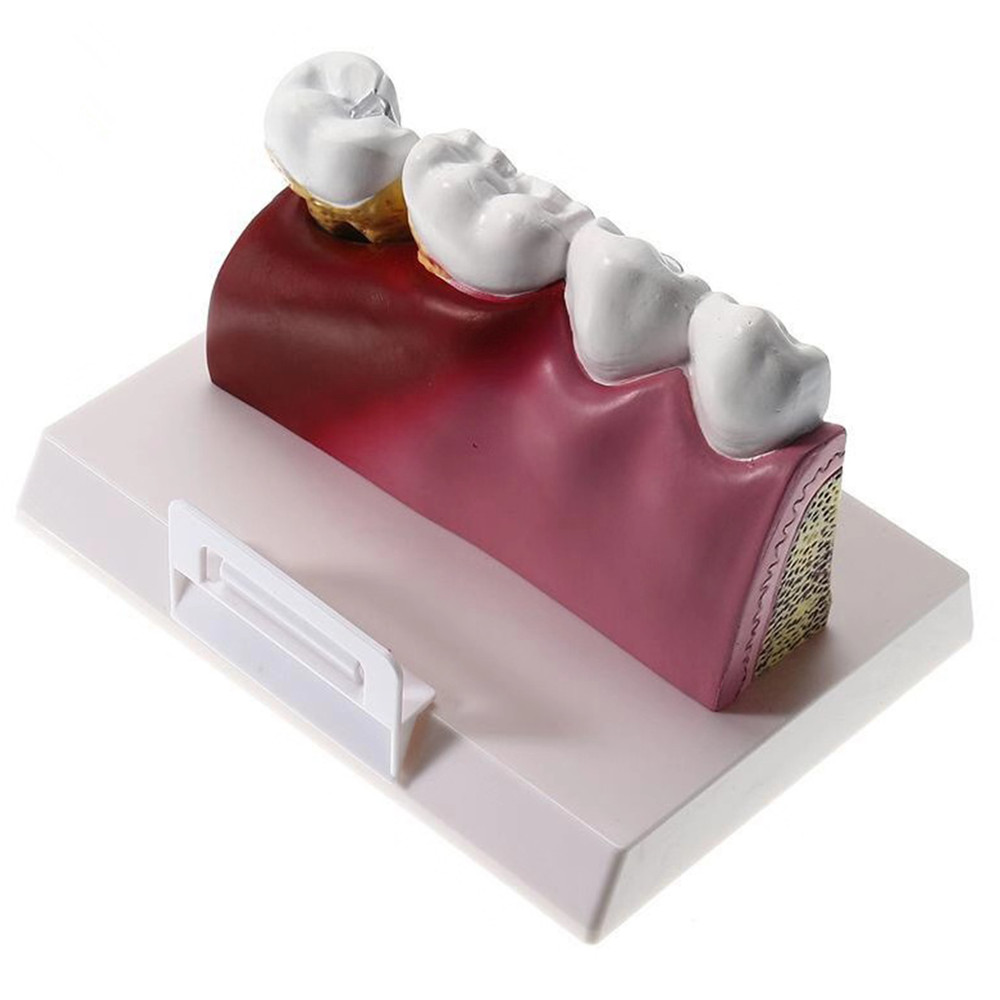 1 Pc Dental Pathological Tooth Model Detachable Teeth Decay Anatomical Model