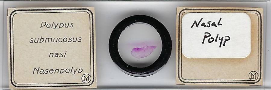 Human Nasal Polyp Pathology Microscope Slide by Moeller