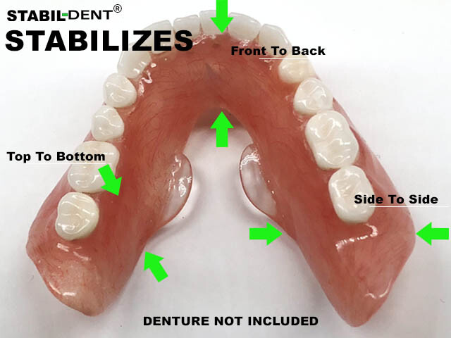 Lower Denture Stabilizers DIY Kit-Affordable Denture Stabilization