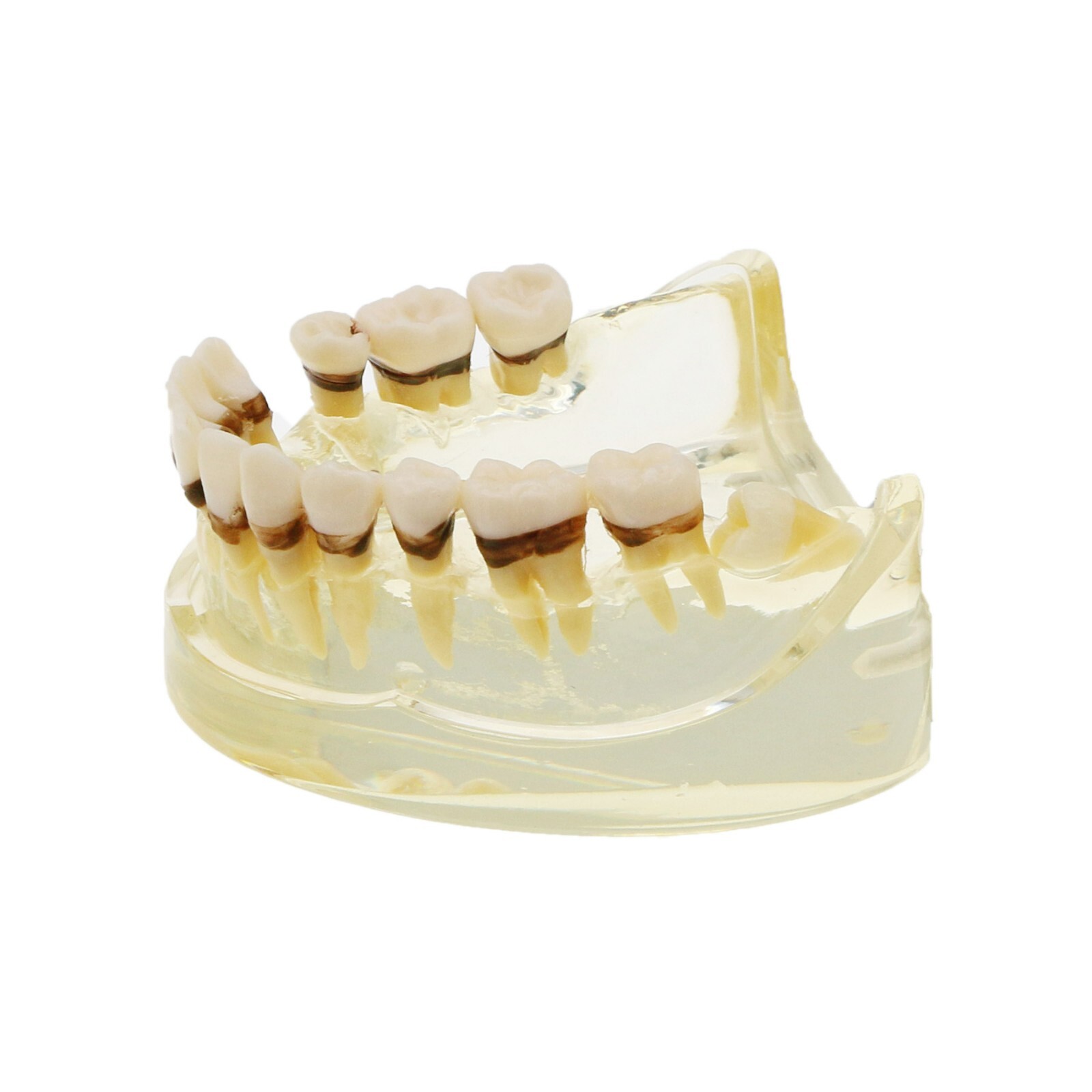 Dental Adult Periodontal Disease Pathological Teeth Typodont Model Removable Gum