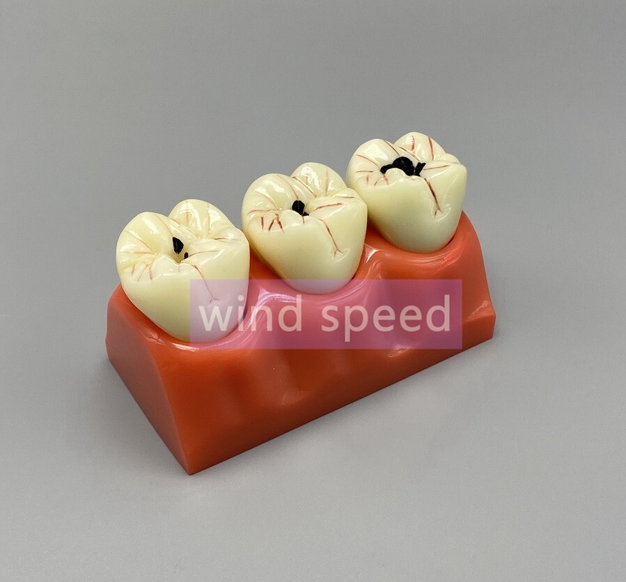 Dental Teaching Model 4 Times Caries Disassembling Comparations Implant Model