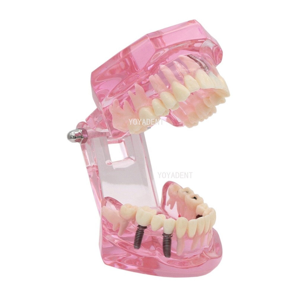 Multiple Types Dental Teaching Teeth Model Typodont Ortho Implant Practice Demo