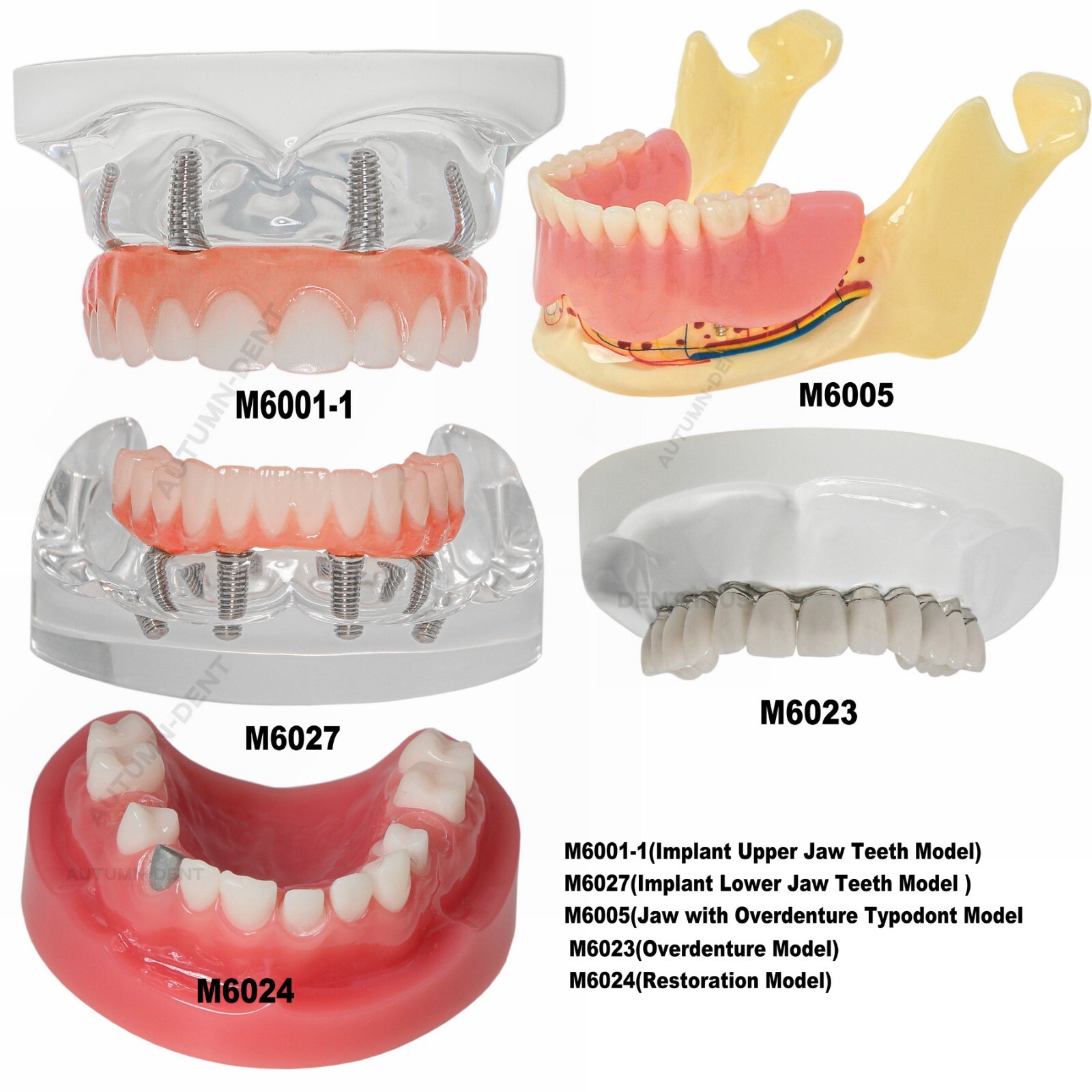 Dental Implant Typodont Teeth Restoration Model Series Overdenture Practice Demo