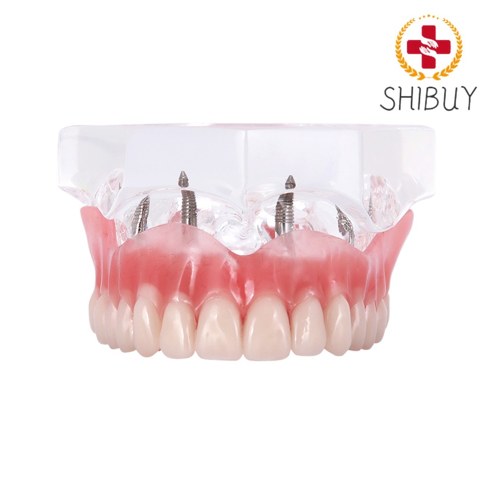 1pc Implant Overdenture Teeth Model Demo Restoration Upper 4 Implants