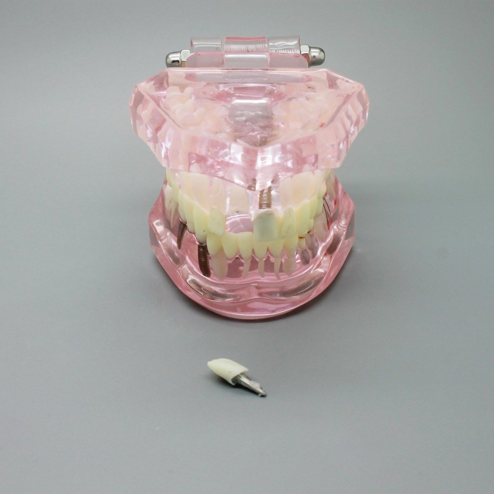 Dental Teeth Model Implant Study Demonstration Restoration Bridge & Crown