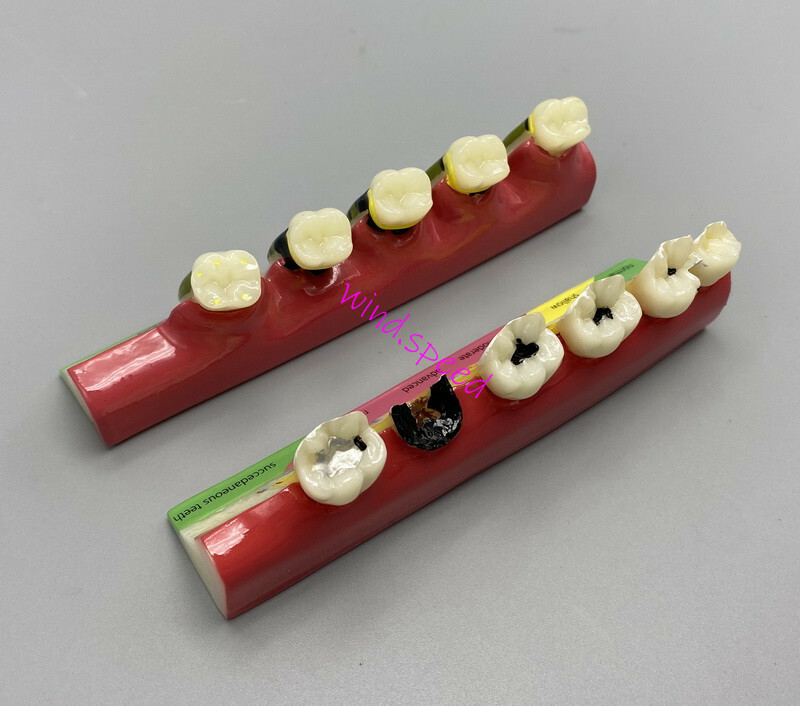 Dental Teeth Dentoform Models Caries Periodontal Disease Study Teaching Model